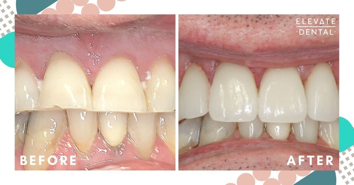 Mark-Elevate-Dental-Whitening-Crown