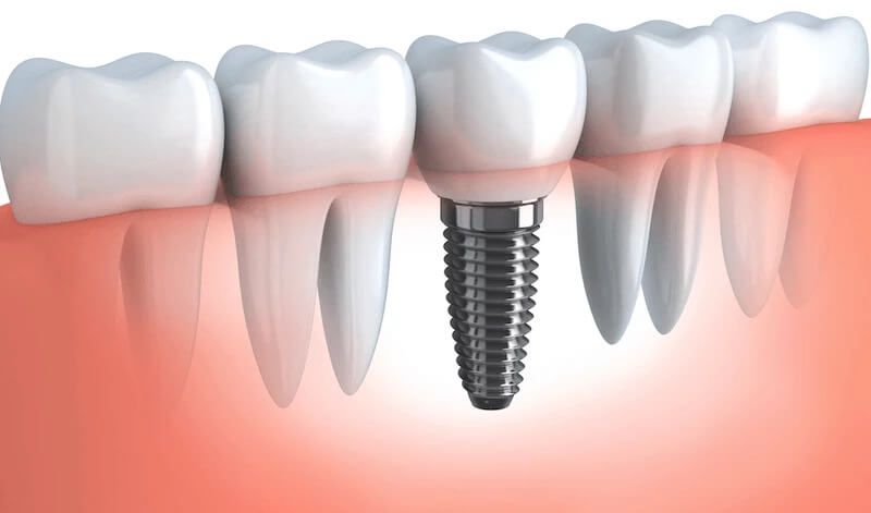 Melbourne_Dental-Implants_Elevate-Dental