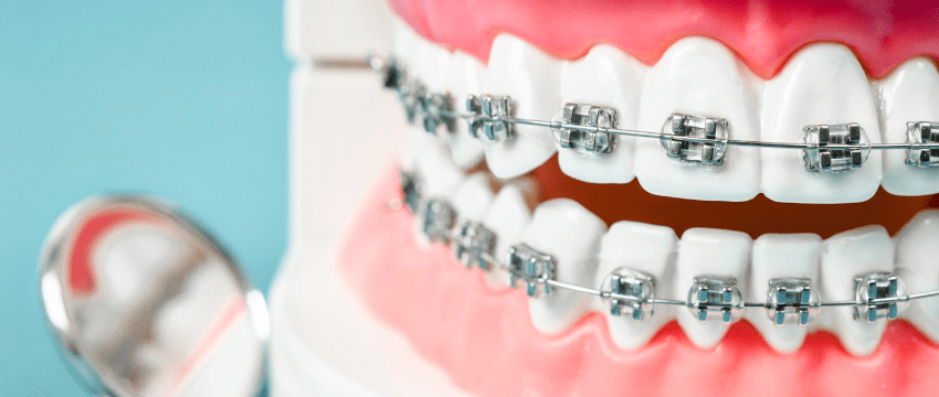 How Much Do Braces Cost in Australia