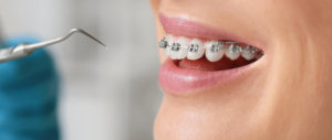 What are the Best Alternatives to Braces